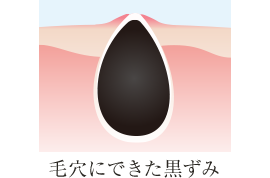 毛穴にできた黒ずみ